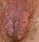 Female genital warts